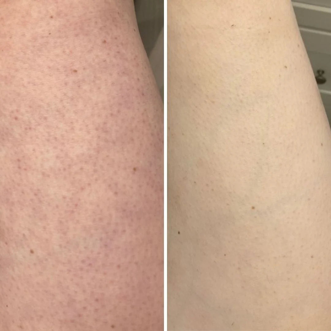 JunoYouth Keratosis Pilaris Eraser Balm