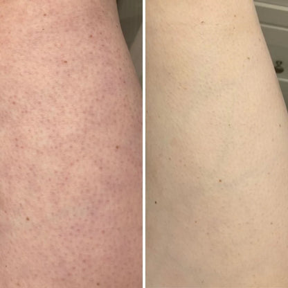 JunoYouth Keratosis Pilaris Eraser Balm