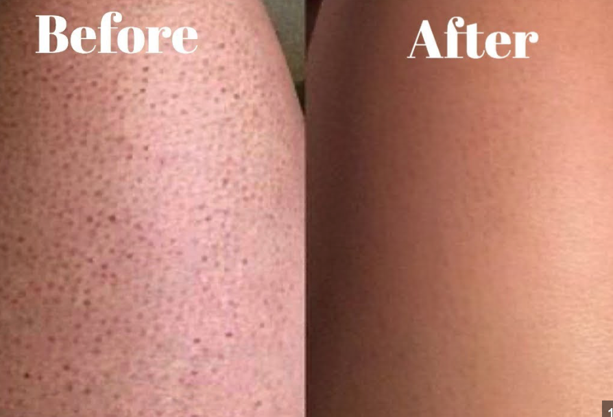 JunoYouth Keratosis Pilaris Eraser Balm