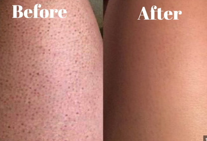 JunoYouth Keratosis Pilaris Eraser Balm