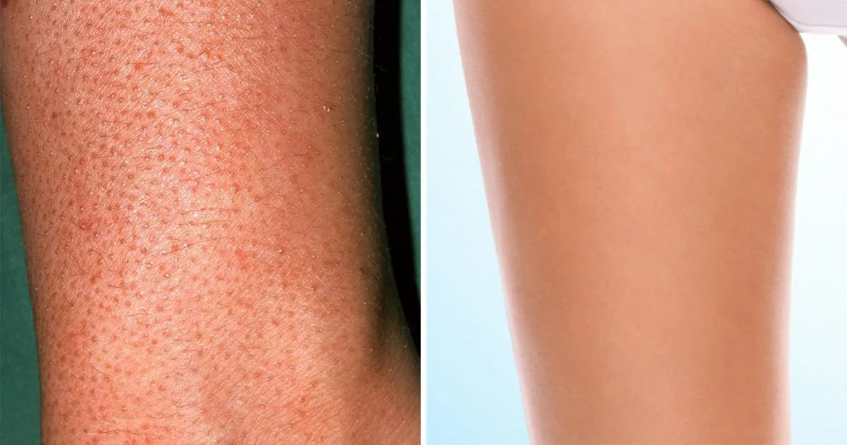 JunoYouth Keratosis Pilaris Eraser Balm
